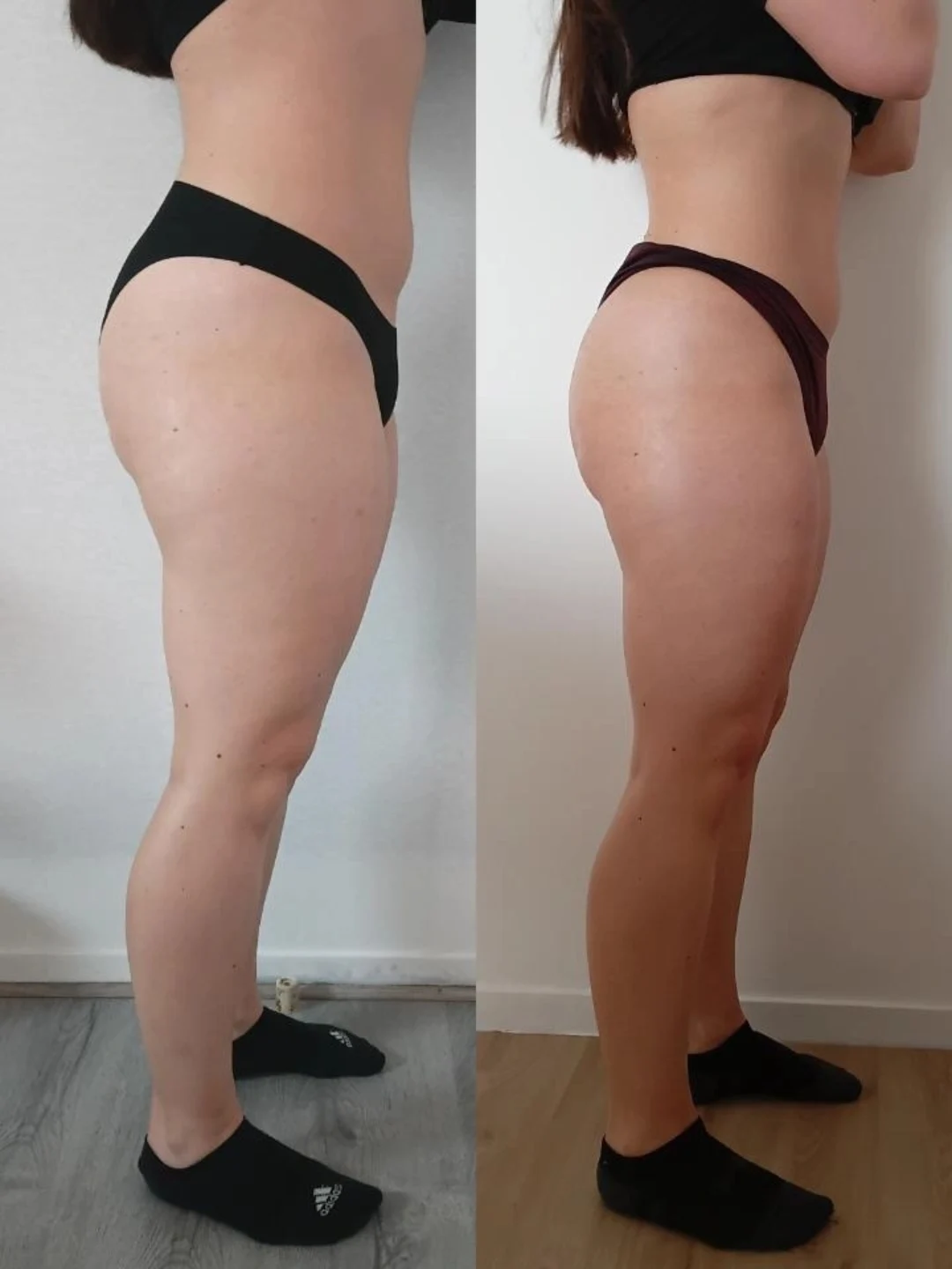 Après - Lifting du visage